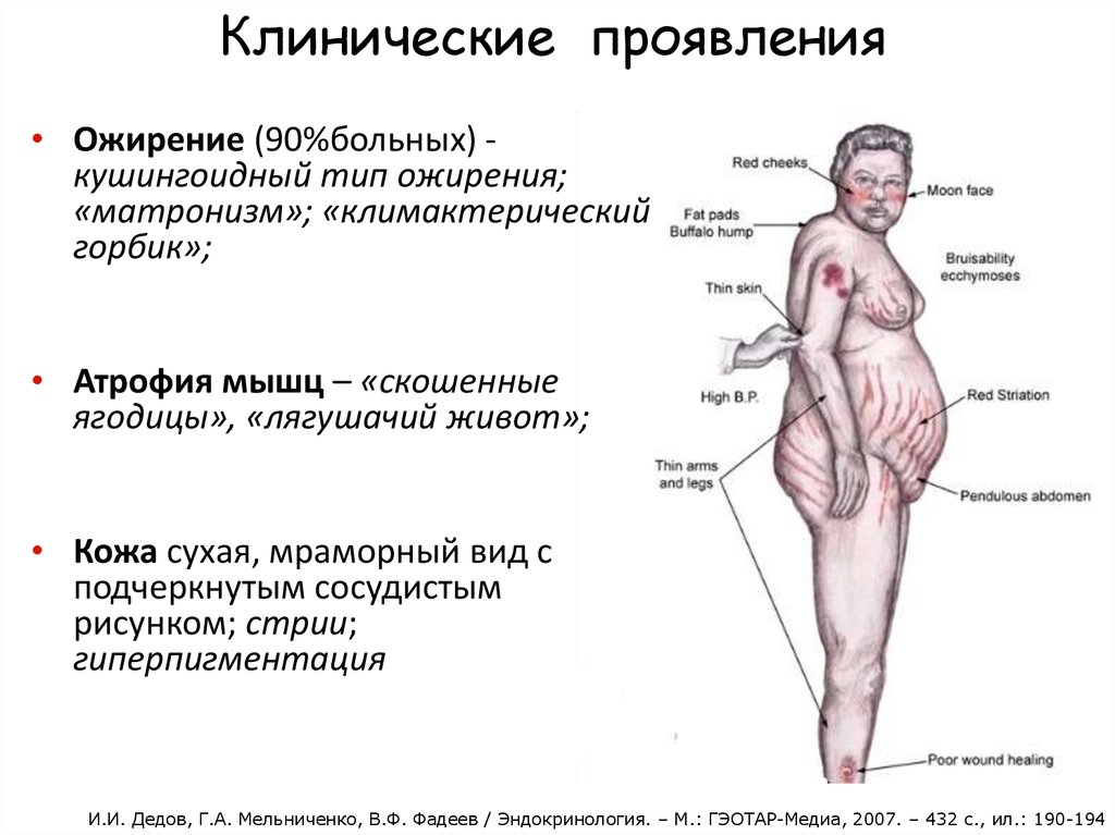 Болезнь иценко кушинга схема