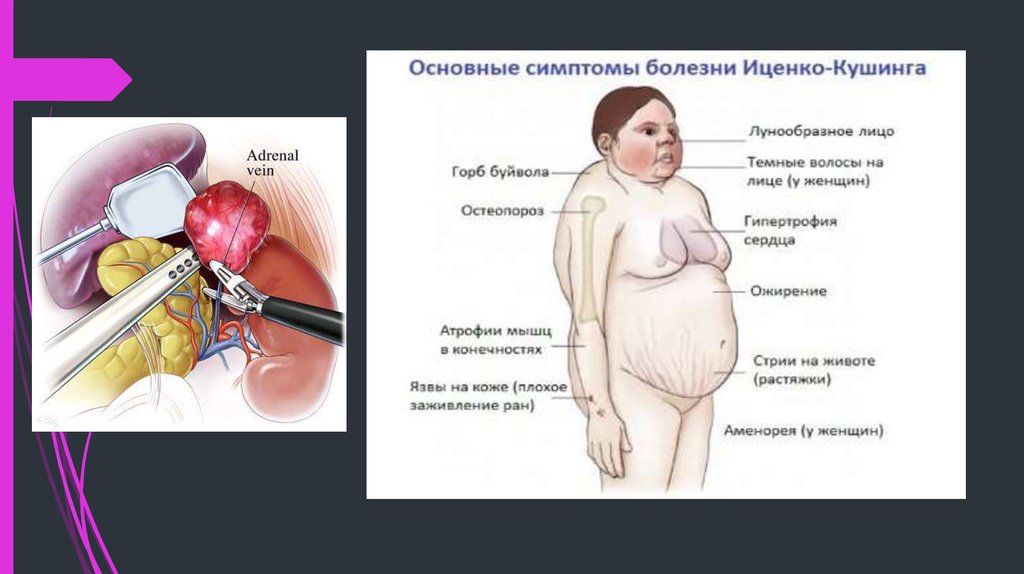 Недостаточность надпочечников презентация