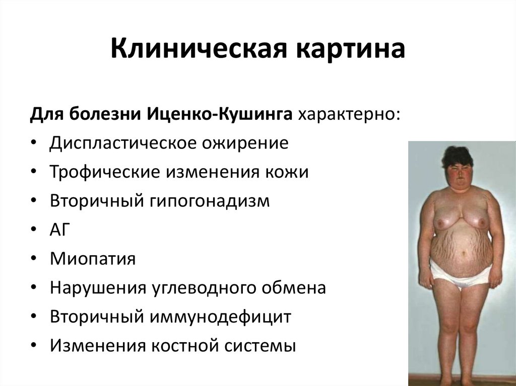 Болезнь иценко кушинга схема