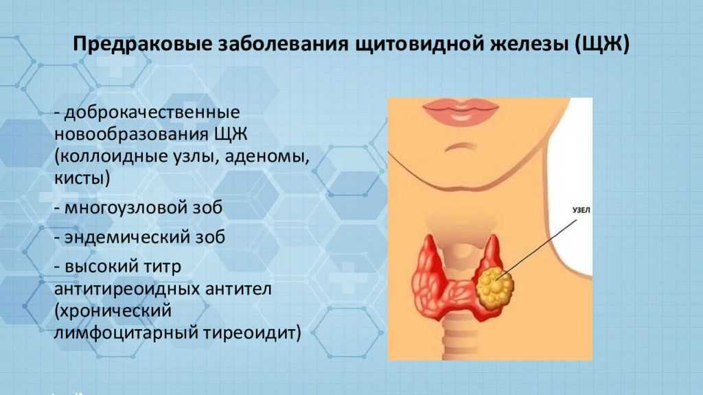 Щитовидная железа больно глотать. Предраковые состояния щитовидной железы. Что такое коллоид в узле щитовидной железы. Предраковые заболевания щитовидной железы. Новообразование в щитовидной железе.