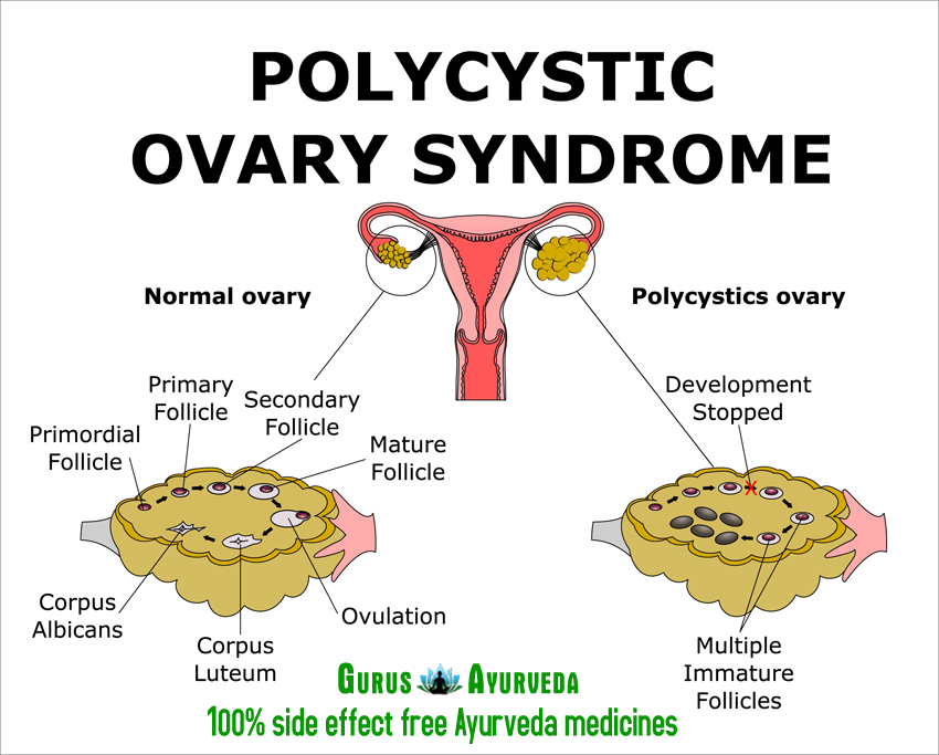 Pcos это. Синдром поликистозных яичников. Синдром поликистозных яичников патогенез.